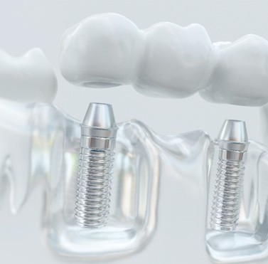 Illustration of dental bridge over dental implants in clear model jaw