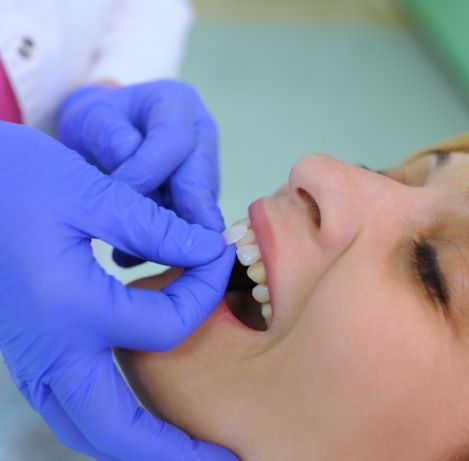 Cosmetic dentist placing a veneer over a patients front upper tooth