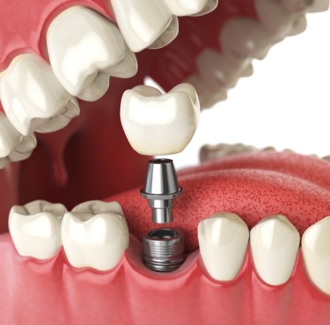 Illustrated dental implant being placed into the lower jaw