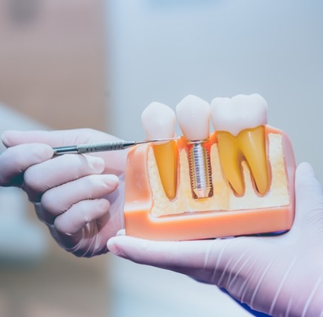 Dentist demonstrating a dental implant model