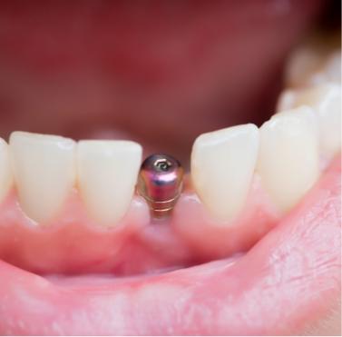 Close up of smile with dental implant abutment visible