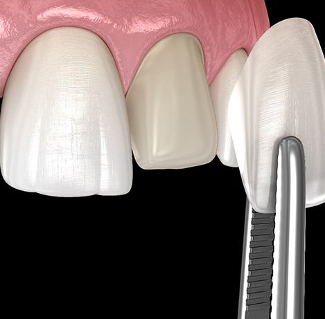 A 3D illustration of veneer placement