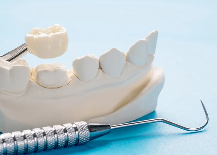 A dental model depicting the lower jaw with a dental crown being held by tweezers above one of the teeth. A dental explorer tool is placed beside the model, illustrating a common crown placement procedure.