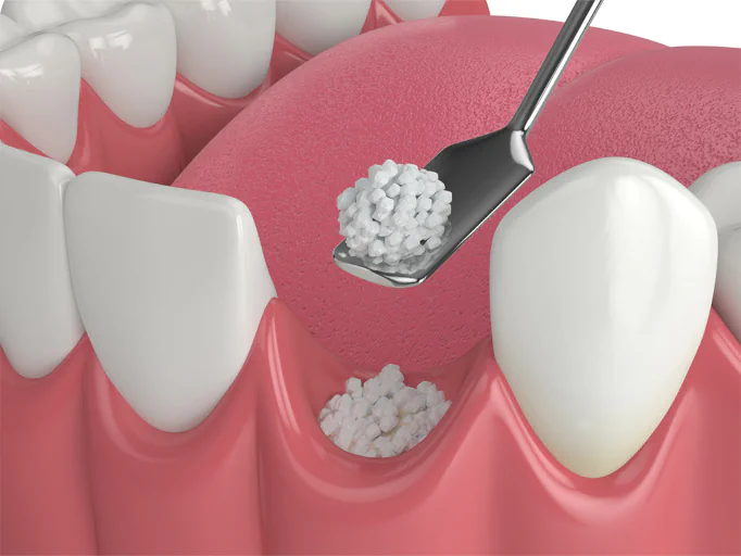 Dental bone grafting available at First Impressions Dentistry in Oklahoma City, OK