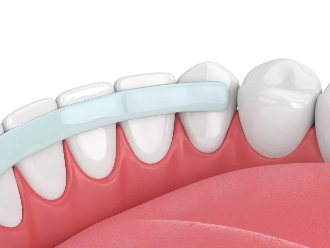 Dental bonding services available at First Impressions Dentistry in Oklahoma City, CA
