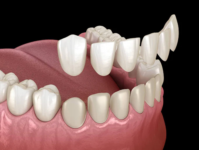 Dental veneers services at First Impressions Dentistry in Oklahoma City, OK