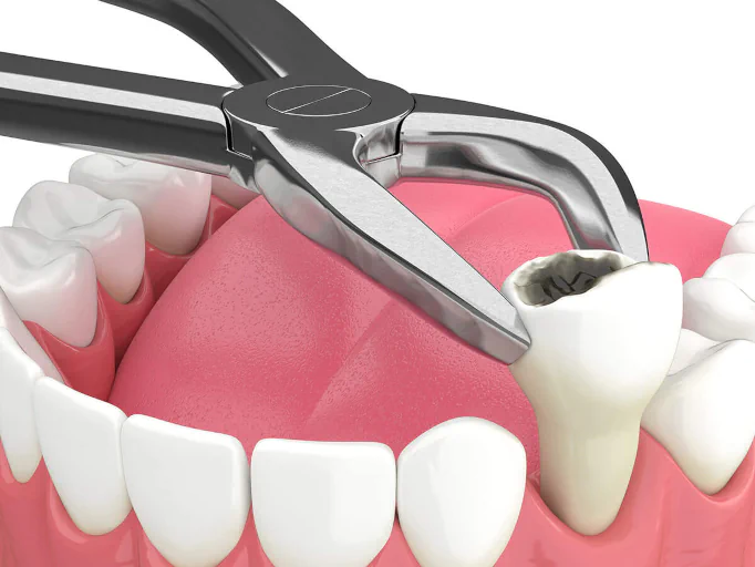 Tooth extractions available at First Impressions Dentistry in Oklahoma City, OK