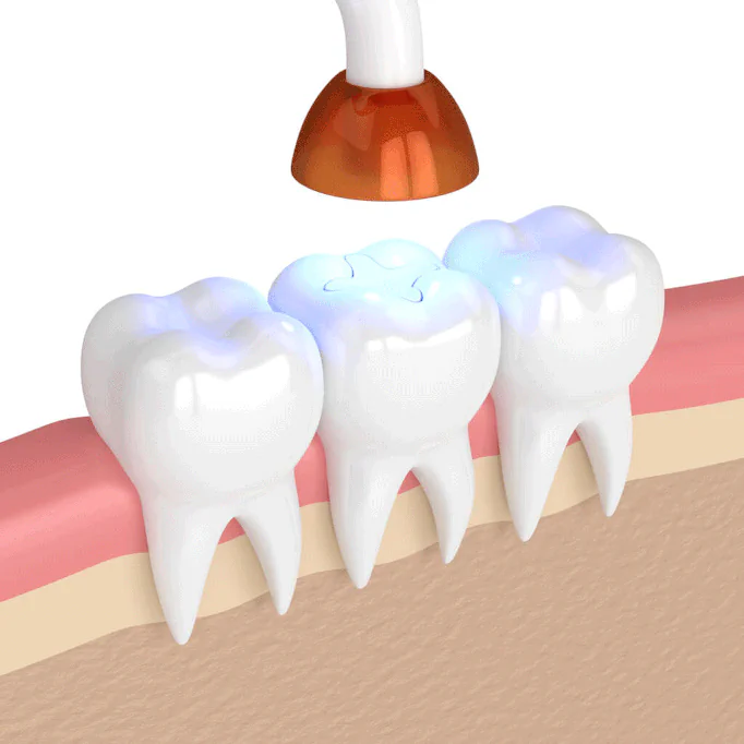 Tooth Fillings in Oklahoma City & Yukon, OK at First Impressions Dentistry