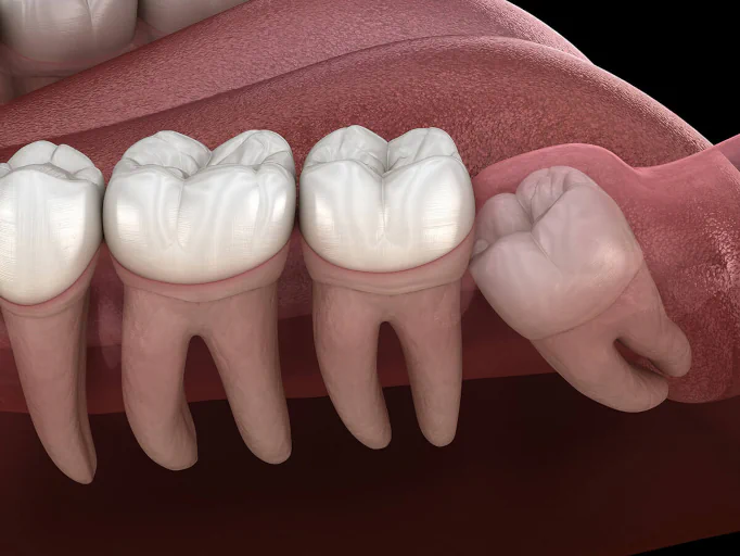 Wisdom tooth removal service at First Impressions Dentistry in Oklahoma City, OK