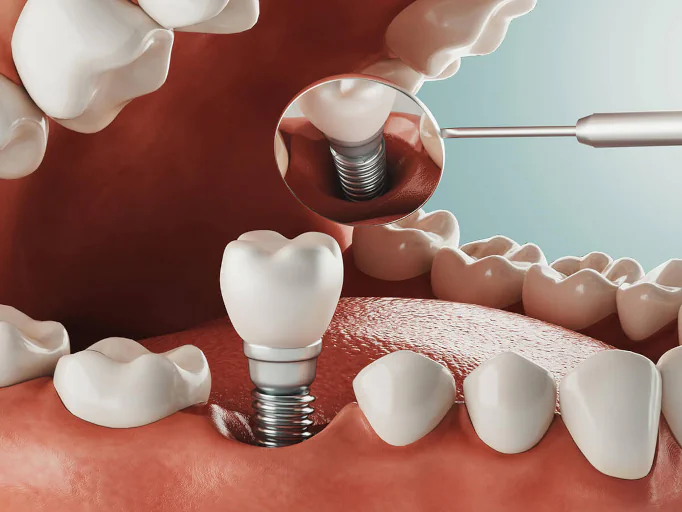Dental implants in Oklahoma City and Yukon, OK, at First Impressions Dentistry